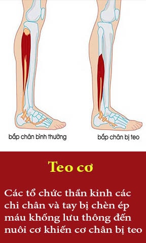 teo cơ